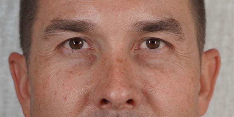Halo Laser Before & After Gallery - Patient 121400677 - Image 1