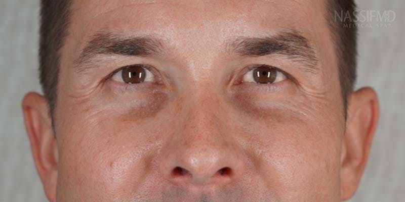 Halo Laser Before & After Gallery - Patient 121400677 - Image 2