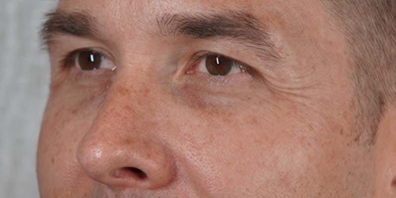Halo Laser Before & After Gallery - Patient 121400677 - Image 3