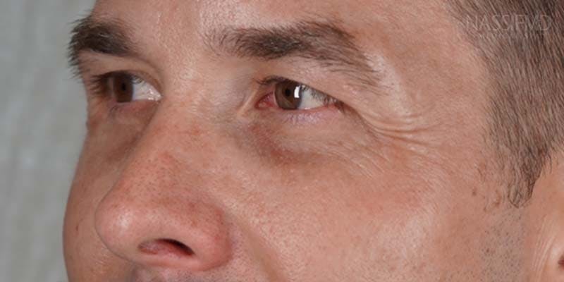 Halo Laser Before & After Gallery - Patient 121400677 - Image 4