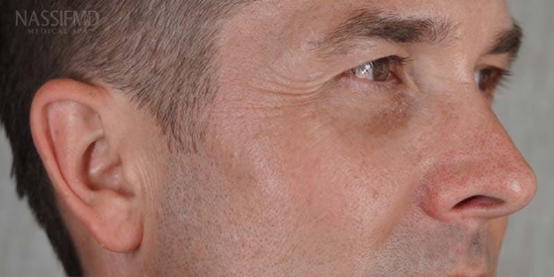 Halo Laser Before & After Gallery - Patient 121400677 - Image 6