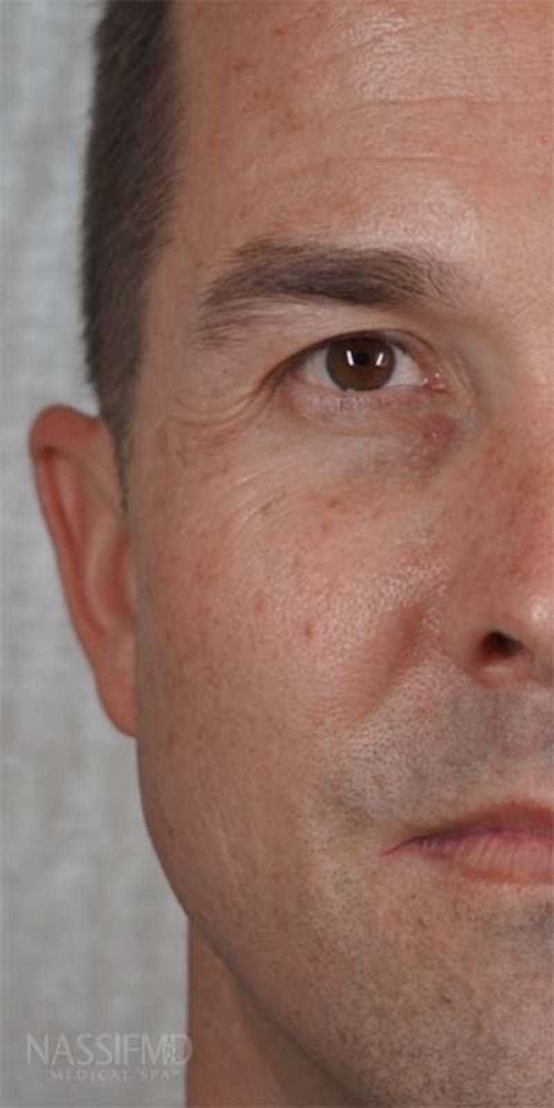Halo Laser Before & After Gallery - Patient 121400677 - Image 7