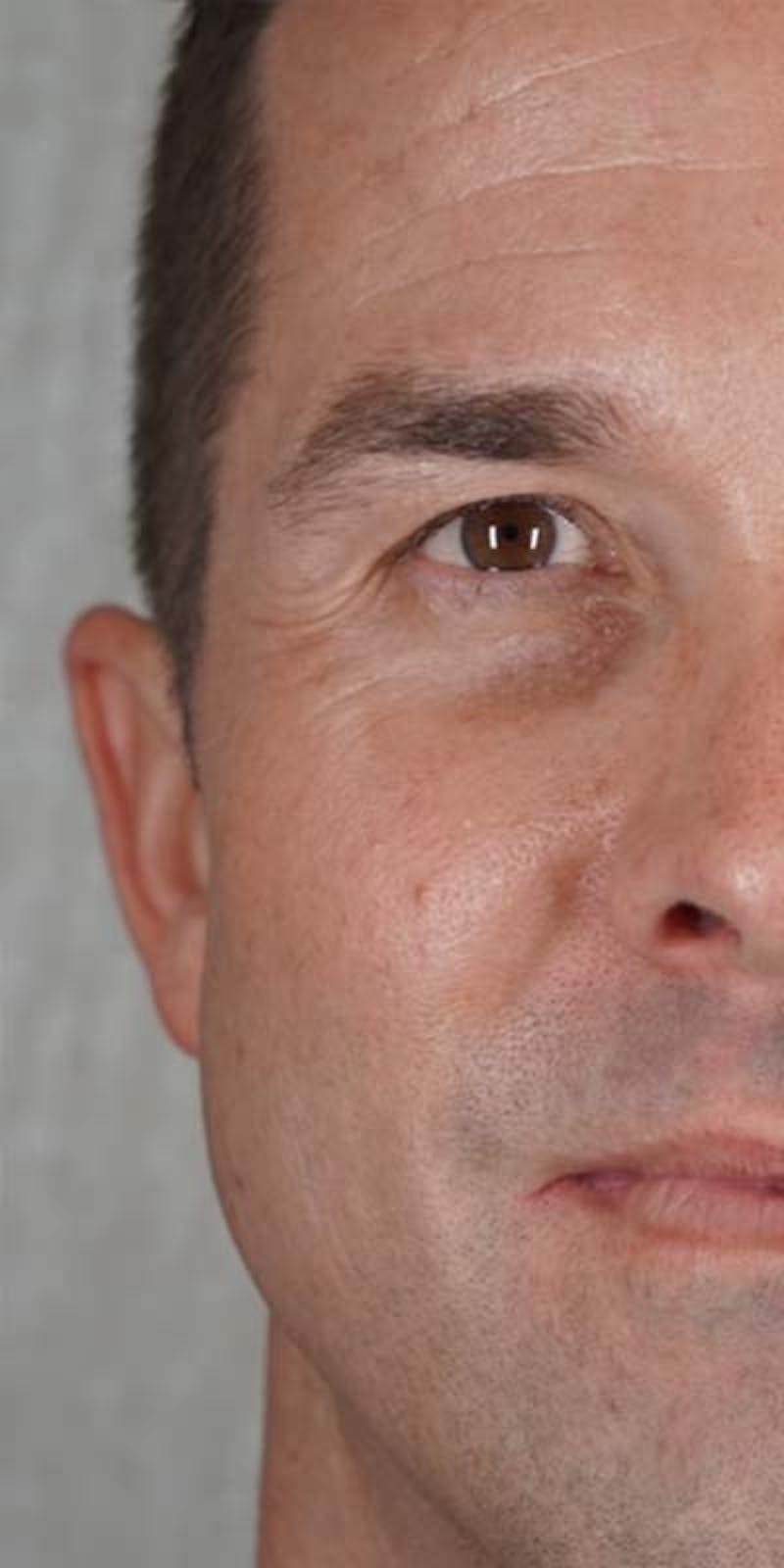 Halo Laser Before & After Gallery - Patient 121400677 - Image 8