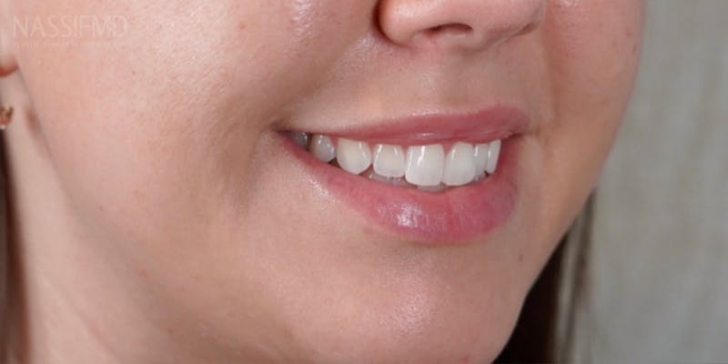 BOTOX Before & After Gallery - Patient 146644276 - Image 4