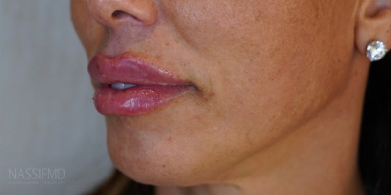 BOTOX Before & After Gallery - Patient 146644275 - Image 4