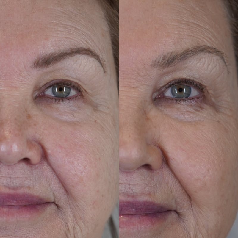 Biorevitalization Peel  Before & After Gallery - Patient 147104818 - Image 1