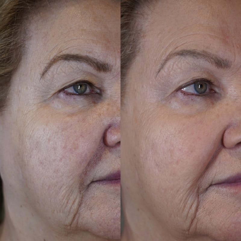 Biorevitalization Peel  Before & After Gallery - Patient 147104818 - Image 2