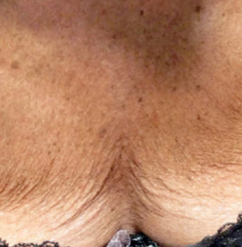 Biorevitalization Peel  Before & After Gallery - Patient 147104854 - Image 1