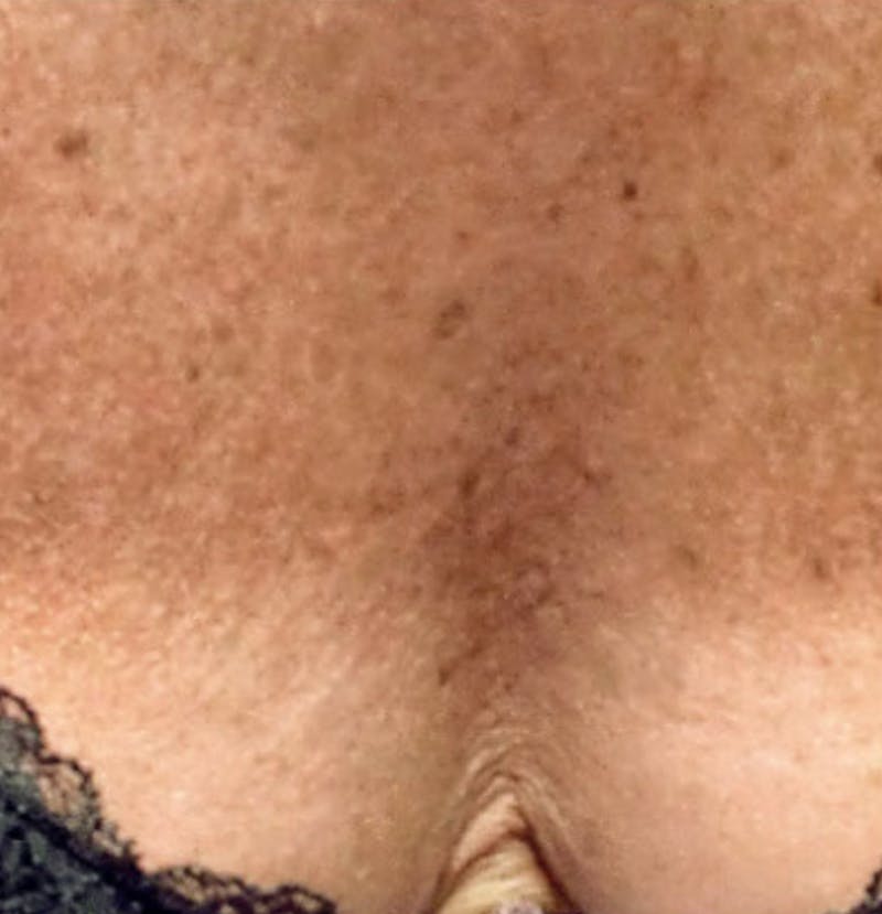 Biorevitalization Peel  Before & After Gallery - Patient 147104854 - Image 2