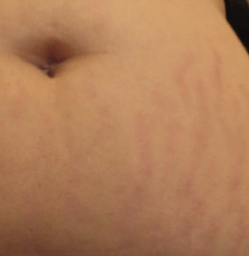 Biorevitalization Peel  Before & After Gallery - Patient 147104855 - Image 2