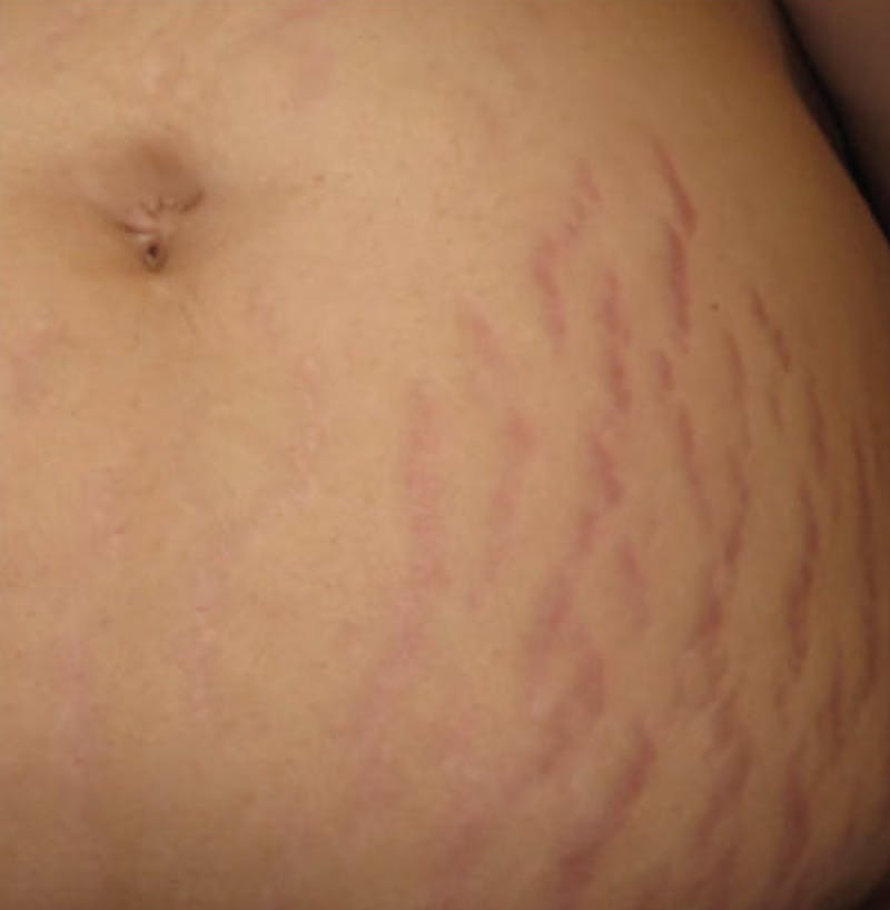 Biorevitalization Peel  Before & After Gallery - Patient 147104855 - Image 1