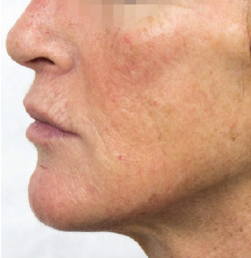 Biorevitalization Peel  Before & After Gallery - Patient 147104856 - Image 2
