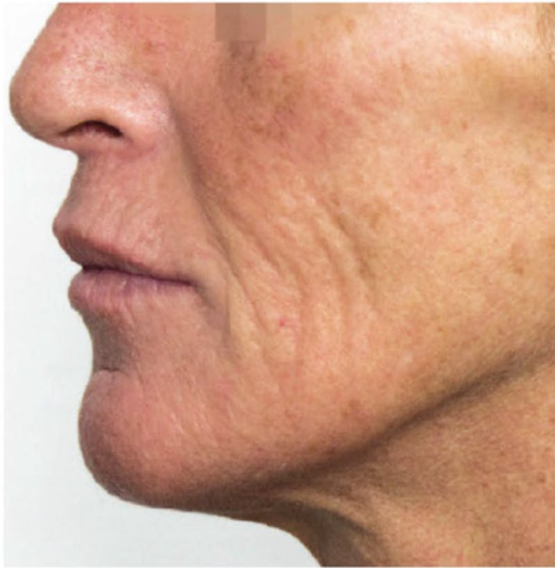 Biorevitalization Peel  Before & After Gallery - Patient 147104856 - Image 1