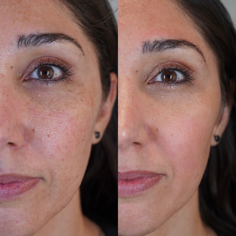 Biorevitalization Peel  Before & After Gallery - Patient 147104853 - Image 1