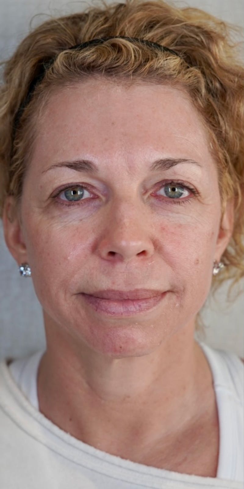 Fillers Before & After Gallery - Patient 147559720 - Image 3