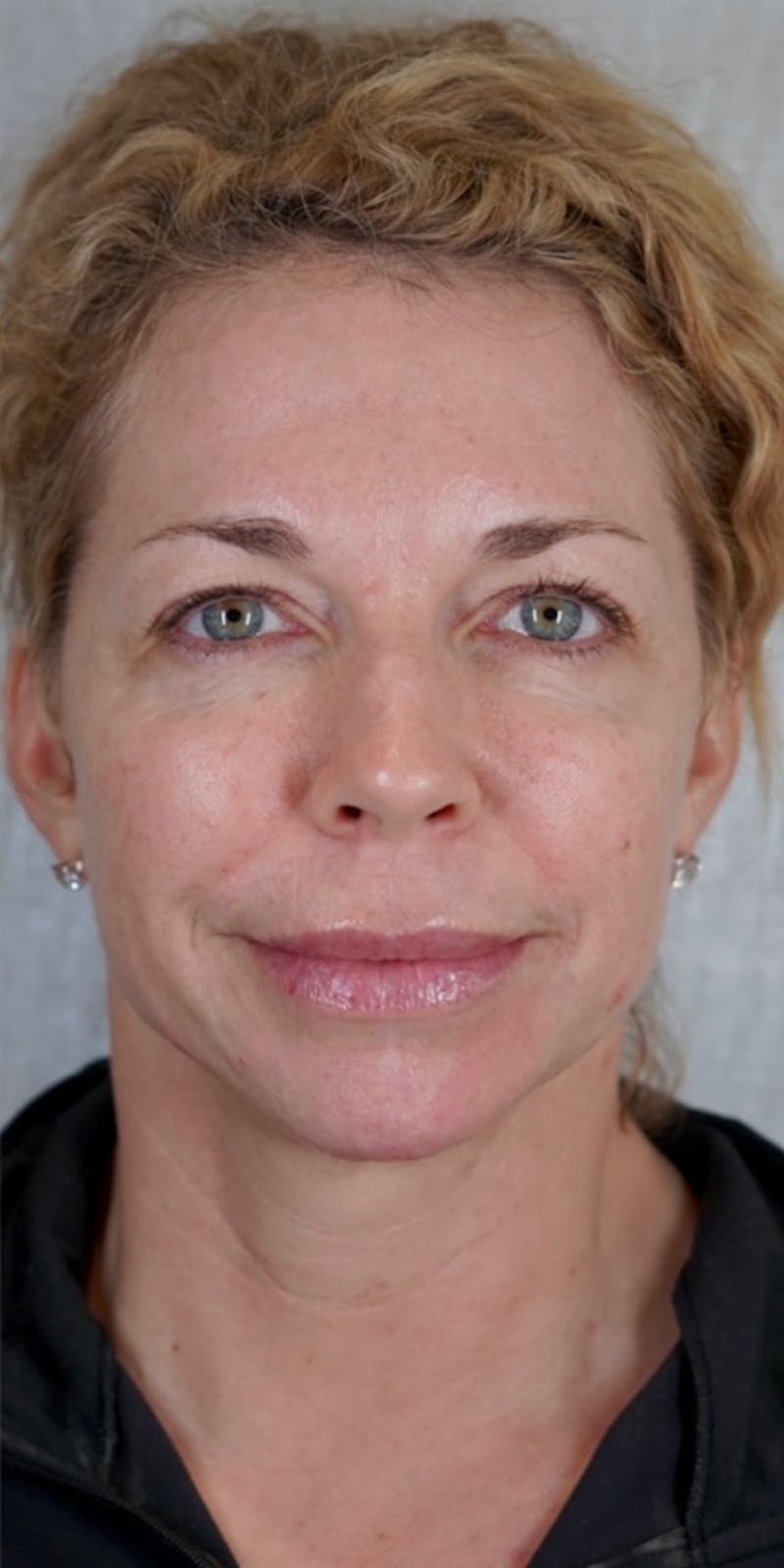Fillers Before & After Gallery - Patient 147559720 - Image 4