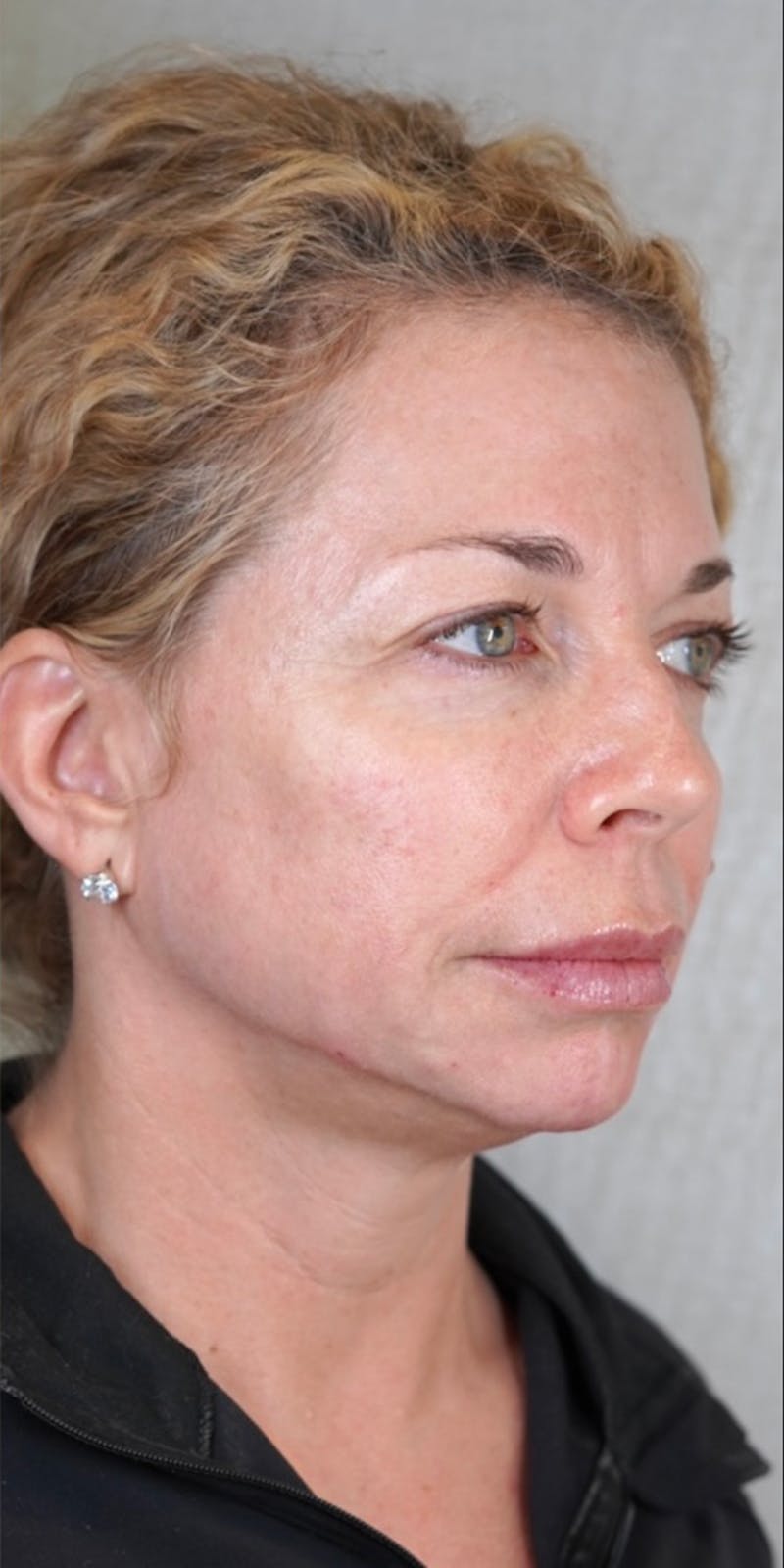 Fillers Before & After Gallery - Patient 147559720 - Image 2