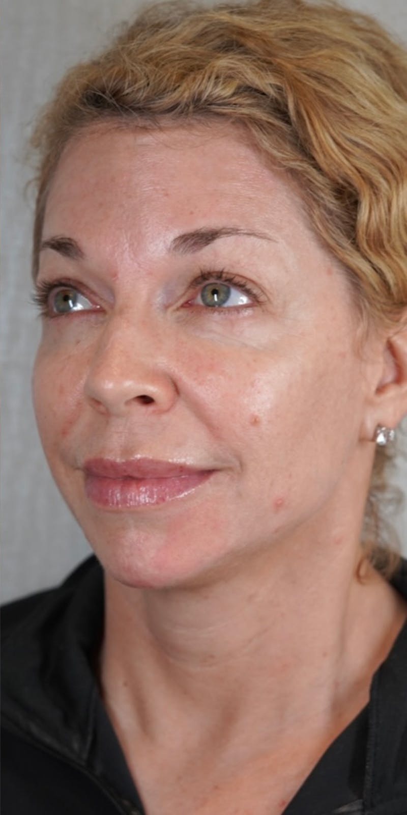 Fillers Before & After Gallery - Patient 147559720 - Image 6