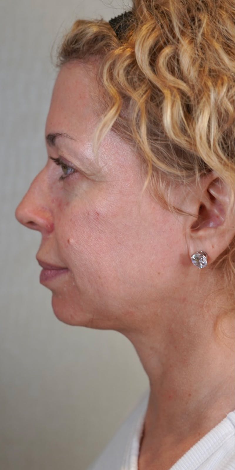 Fillers Before & After Gallery - Patient 147559720 - Image 7