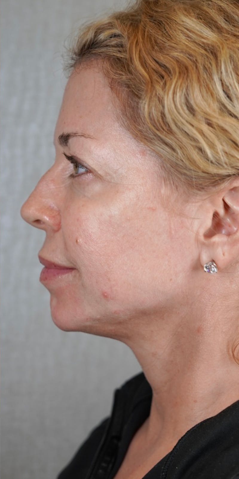 Fillers Before & After Gallery - Patient 147559720 - Image 8