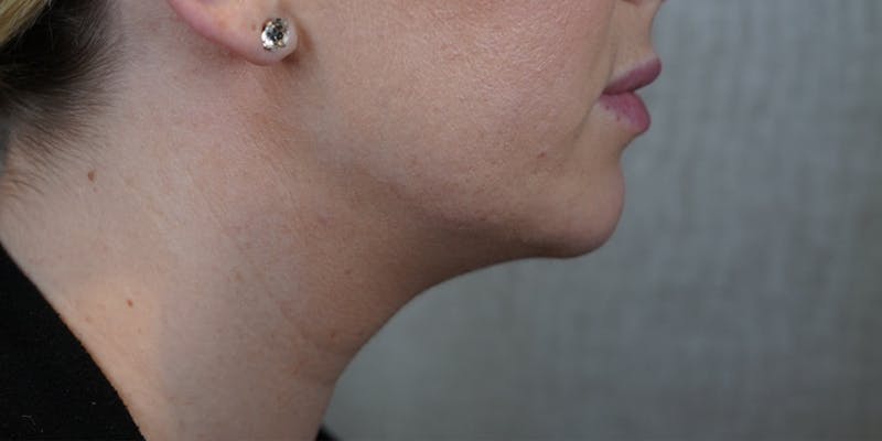 Fillers Before & After Gallery - Patient 147559743 - Image 1