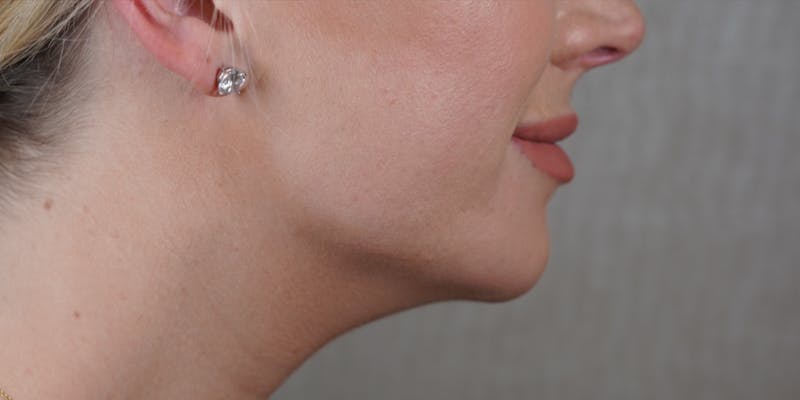 Fillers Before & After Gallery - Patient 147559743 - Image 2