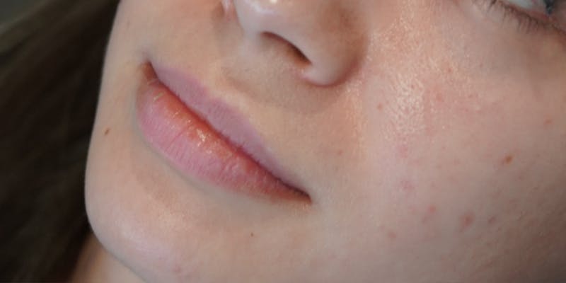 Fillers Before & After Gallery - Patient 147559742 - Image 1
