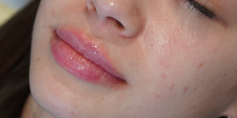 Fillers Before & After Gallery - Patient 147559742 - Image 2