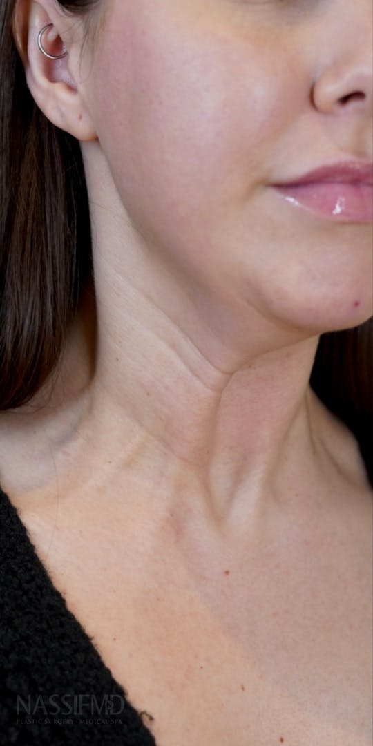 BOTOX Before & After Gallery - Patient 147559777 - Image 1