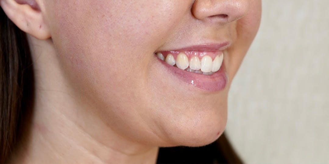 BOTOX Before & After Gallery - Patient 147559777 - Image 3