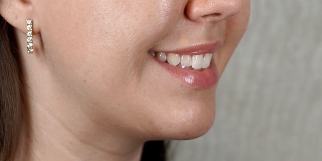 BOTOX Before & After Gallery - Patient 147559777 - Image 4