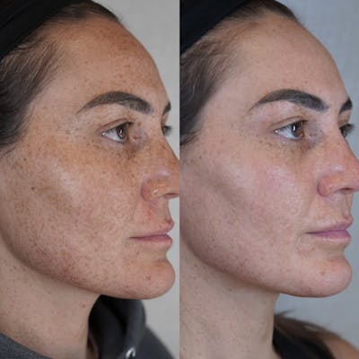 BBL (Broadband Light) Before & After Gallery - Patient 148447964 - Image 1