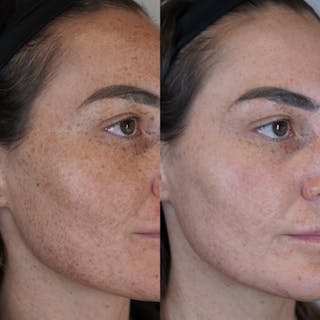 BBL (Broadband Light) Before & After Gallery - Patient 148447964 - Image 2