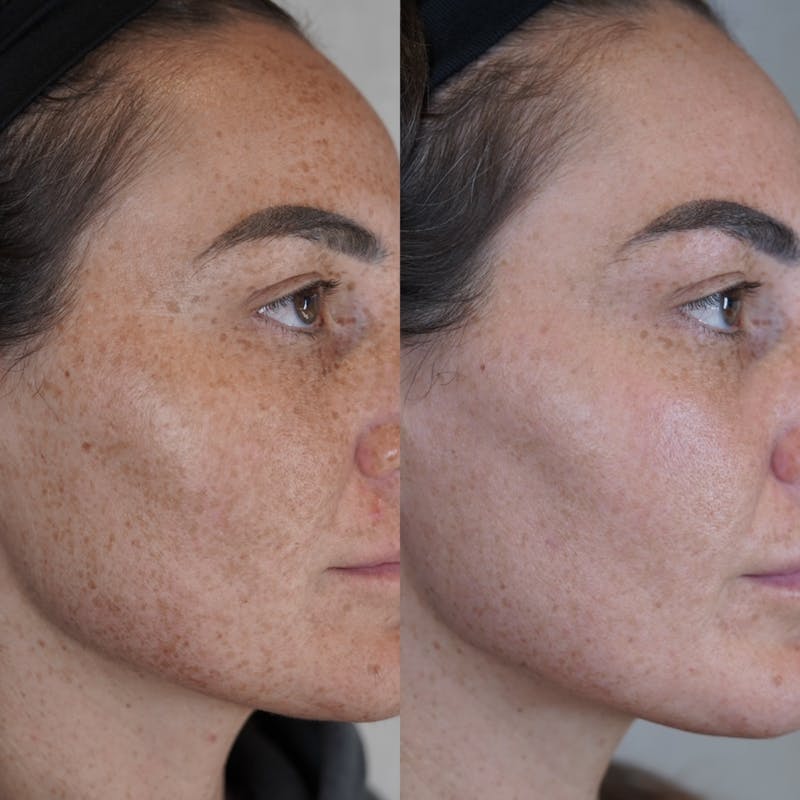 BBL (Broadband Light) Before & After Gallery - Patient 148447964 - Image 3