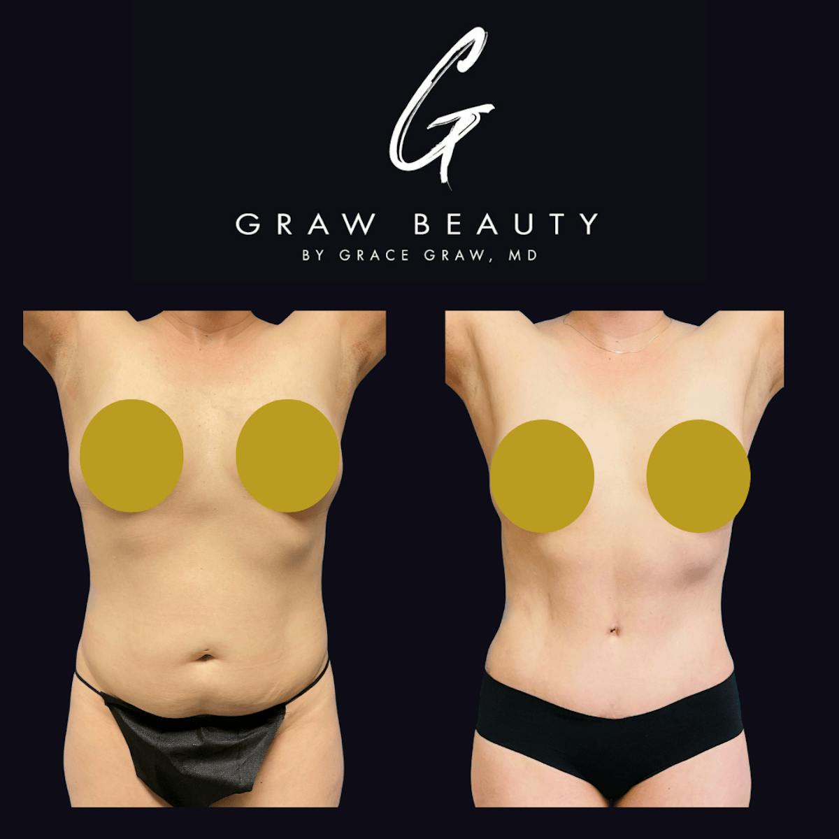 Abdominoplasty Before & After Gallery - Patient 122446275 - Image 1
