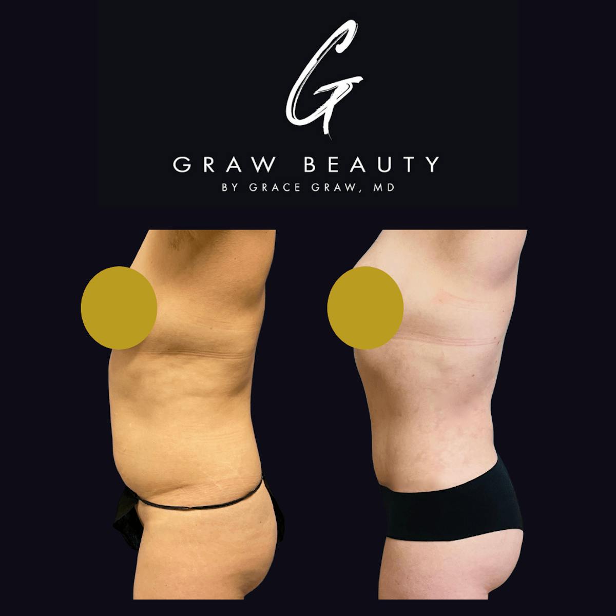 Abdominoplasty Before & After Gallery - Patient 122446275 - Image 2