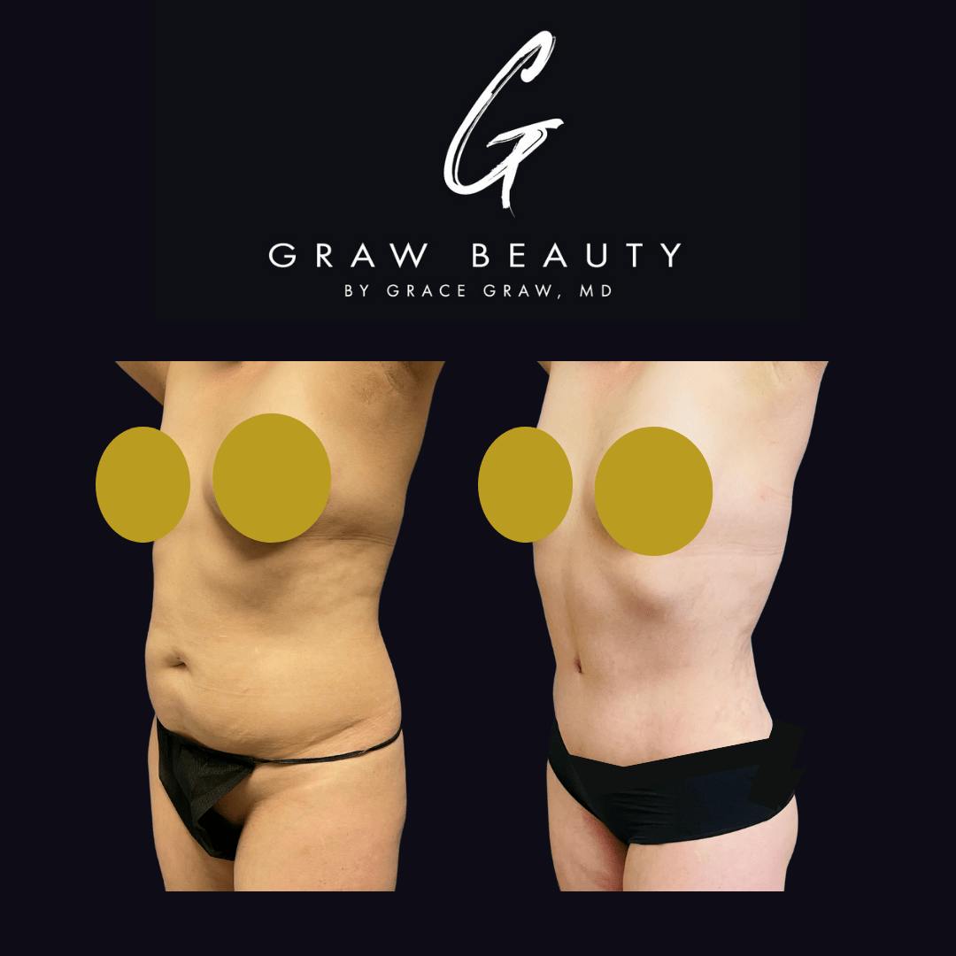Abdominoplasty Before & After Gallery - Patient 122446275 - Image 3