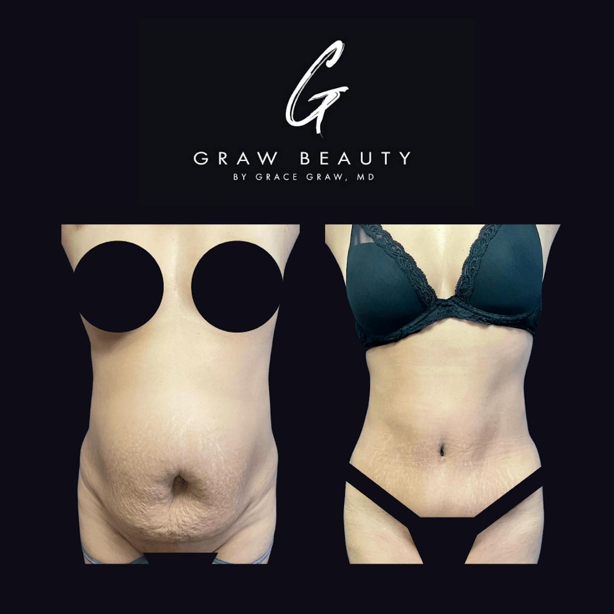 Abdominoplasty Before & After Gallery - Patient 122446276 - Image 1