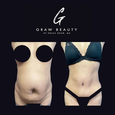 Abdominoplasty Before & After Gallery - Patient 122446276 - Image 1
