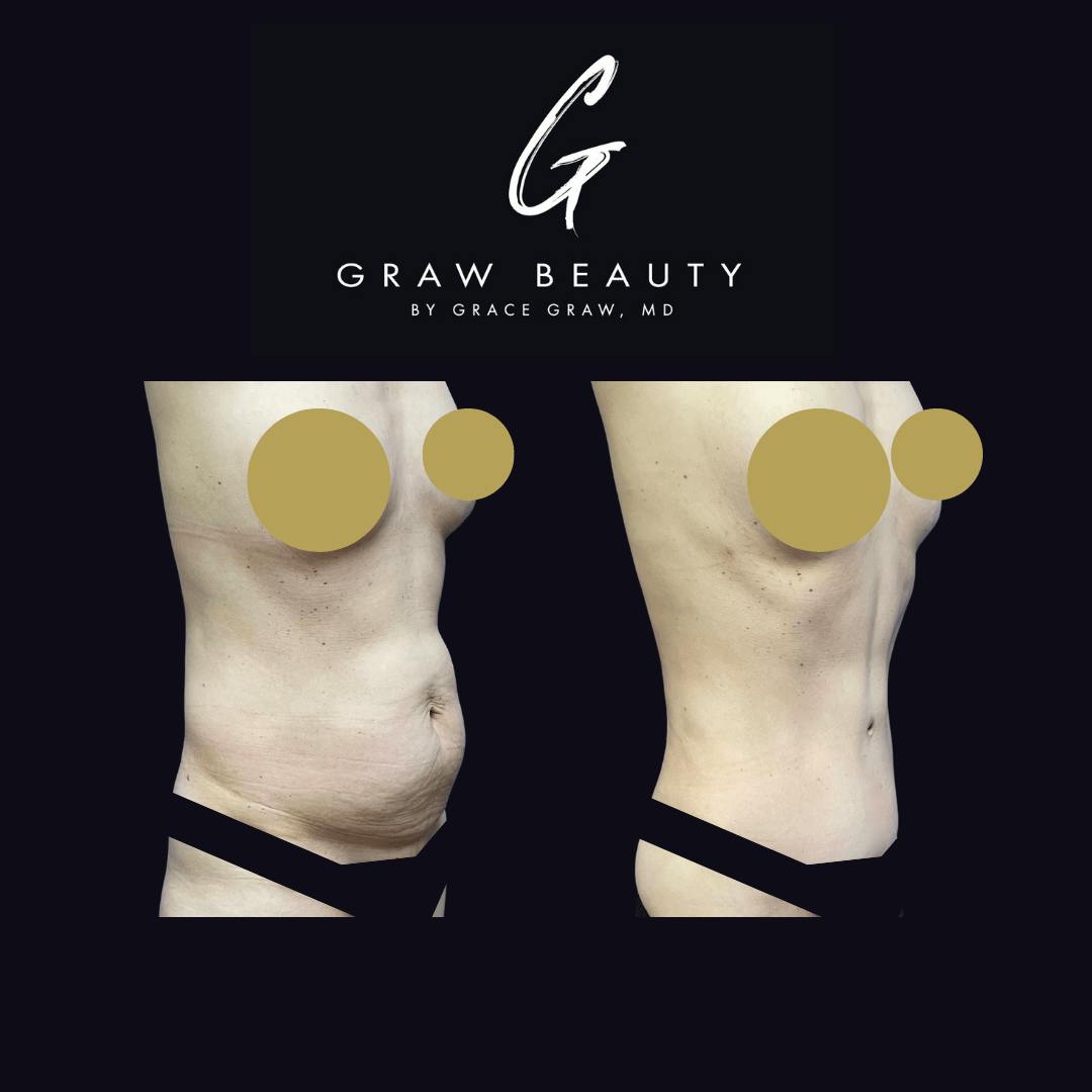 Abdominoplasty Before & After Gallery - Patient 122446277 - Image 2