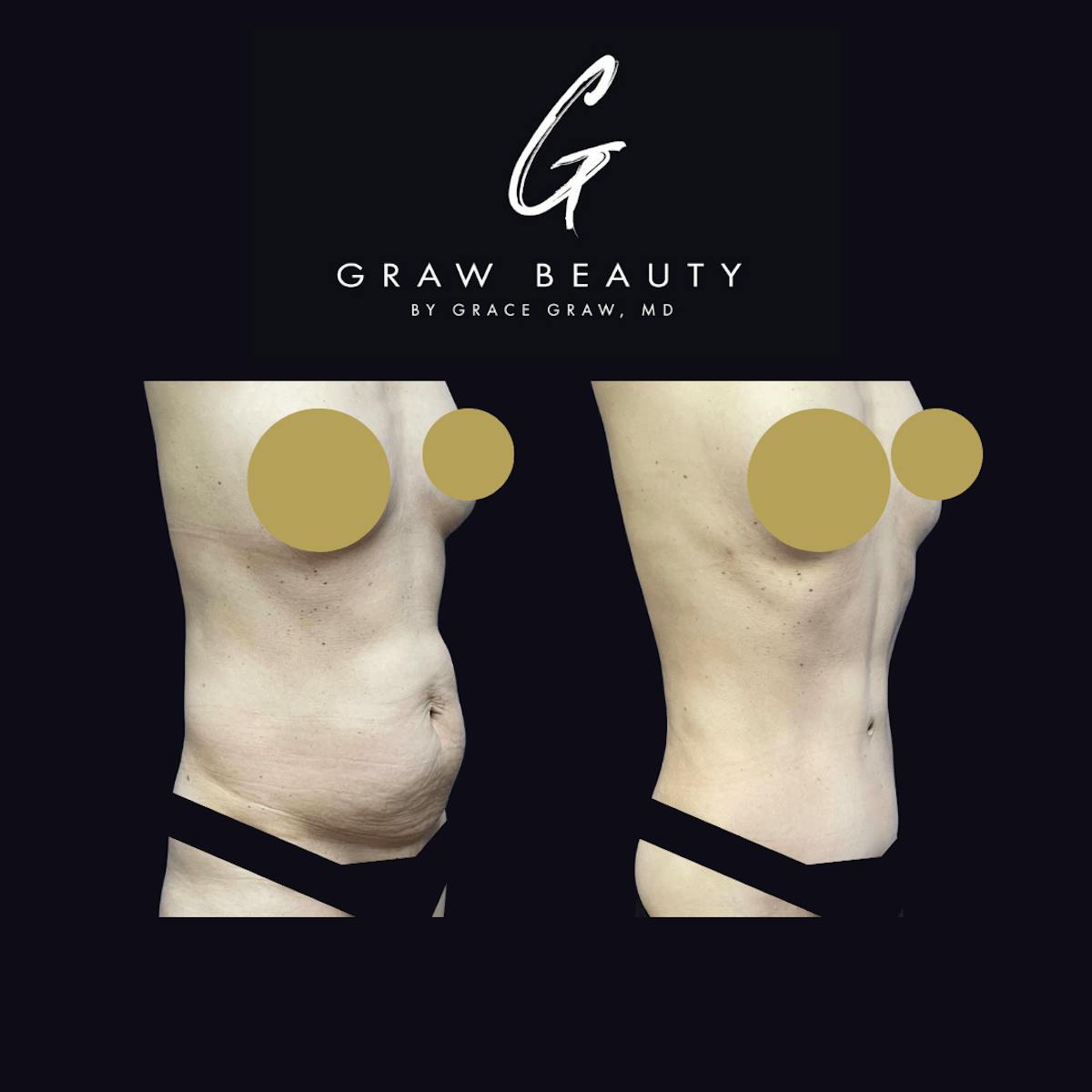 Abdominoplasty Before & After Gallery - Patient 122446277 - Image 2