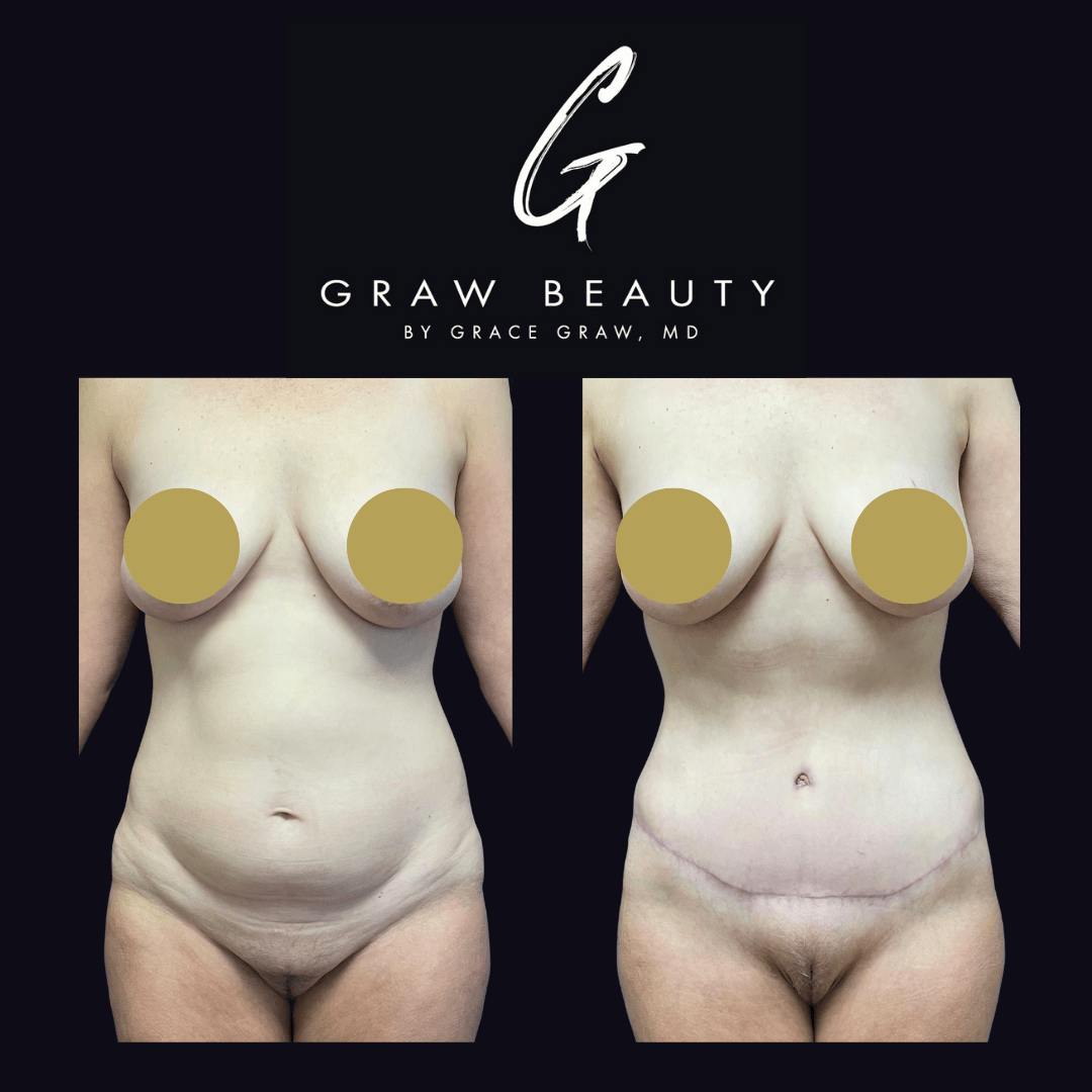 Abdominoplasty Before & After Gallery - Patient 122446278 - Image 1