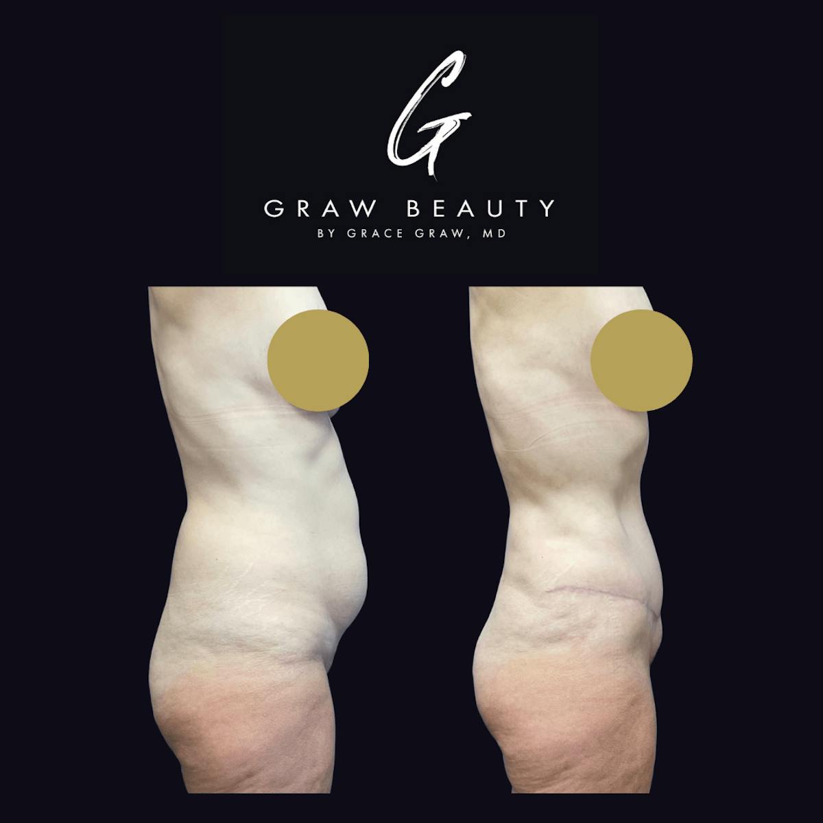 Abdominoplasty Before & After Gallery - Patient 122446278 - Image 2