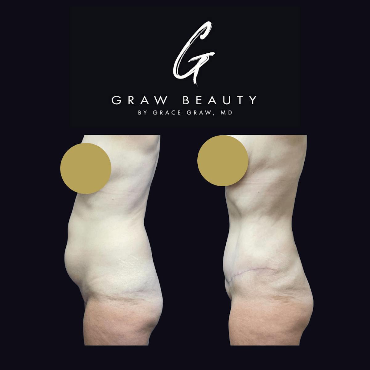Abdominoplasty Before & After Gallery - Patient 122446278 - Image 3