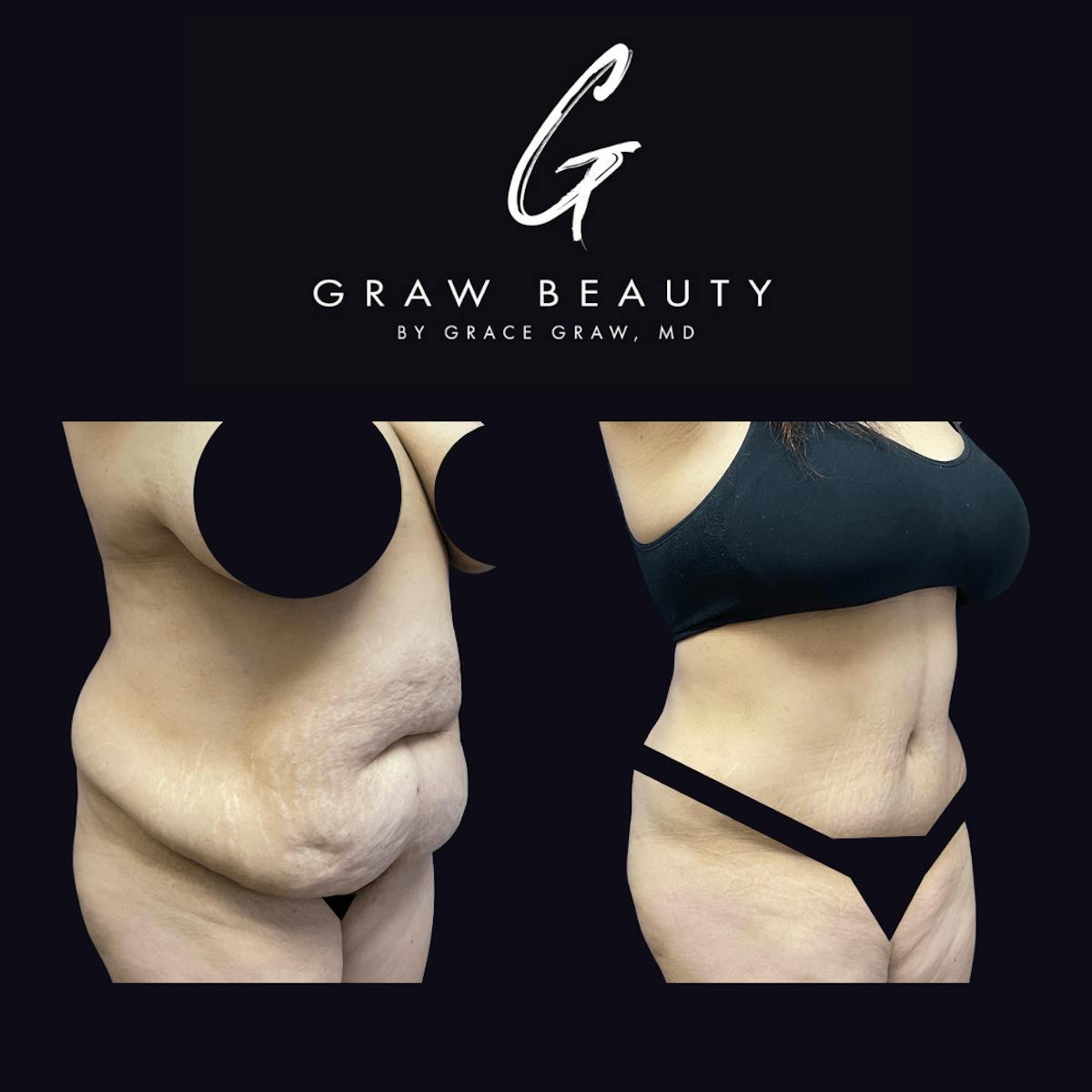 Abdominoplasty Before & After Gallery - Patient 122446279 - Image 2