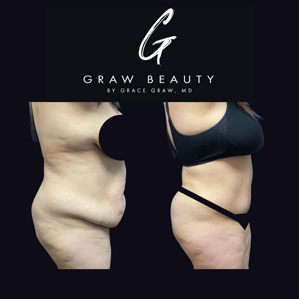 Abdominoplasty Before & After Gallery - Patient 122446279 - Image 3