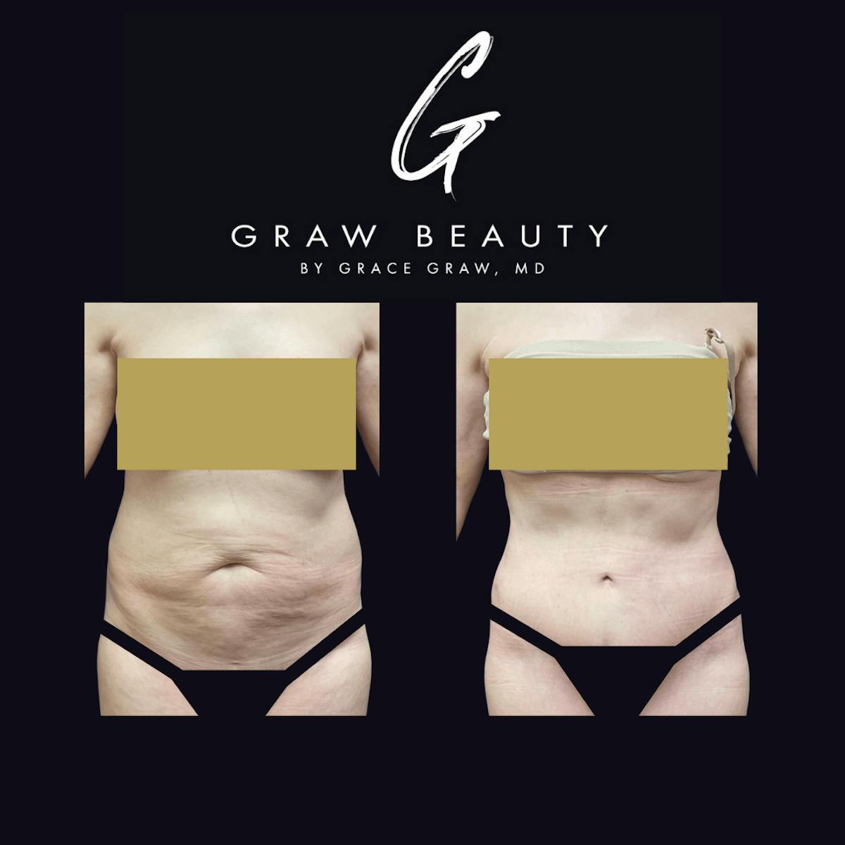 Abdominoplasty Before & After Gallery - Patient 122446280 - Image 1