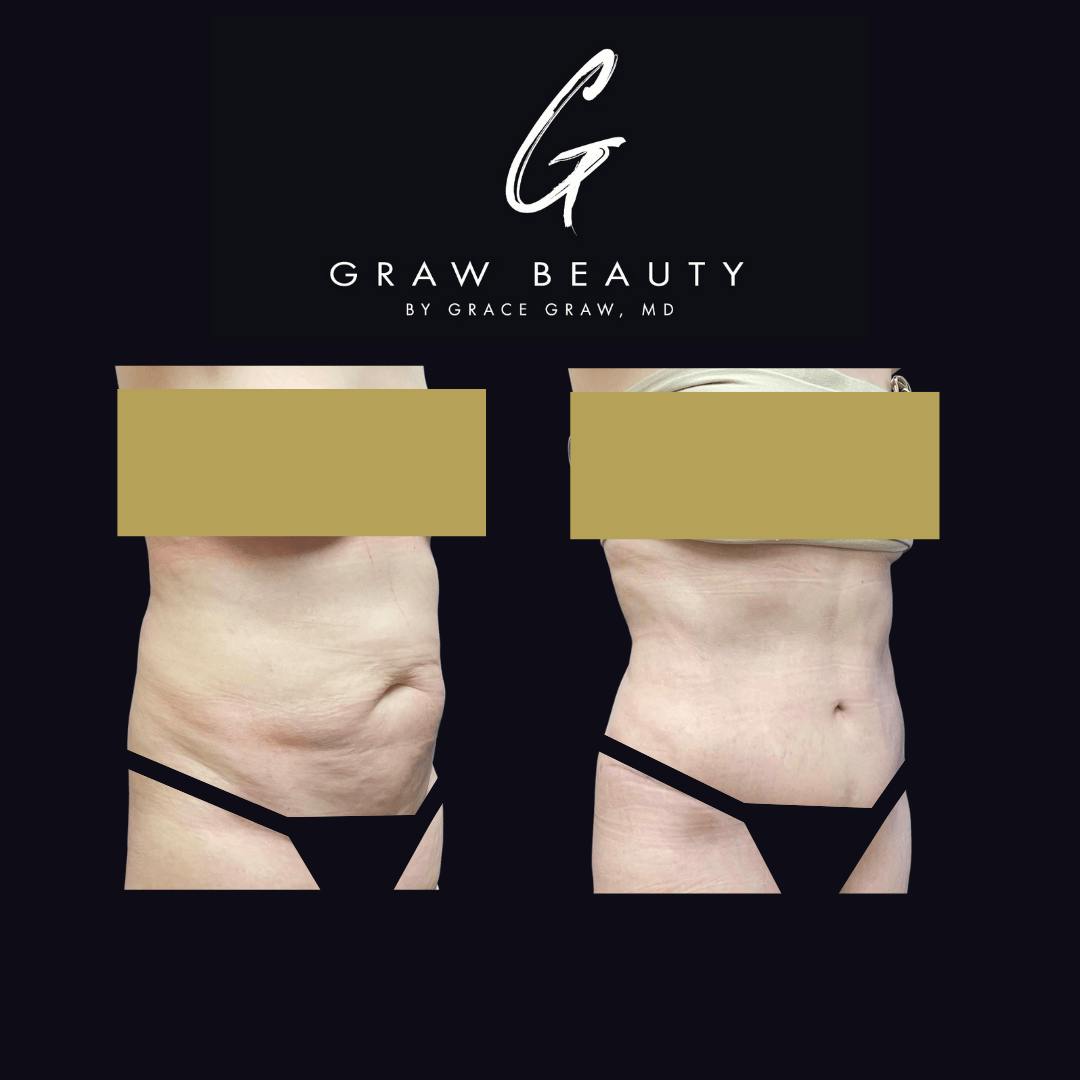 Abdominoplasty Before & After Gallery - Patient 122446280 - Image 2