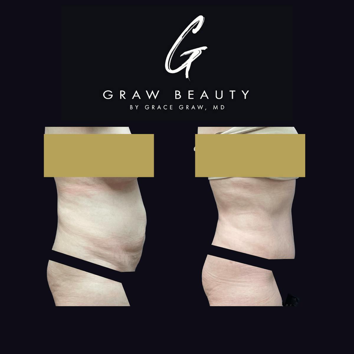 Abdominoplasty Before & After Gallery - Patient 122446280 - Image 3