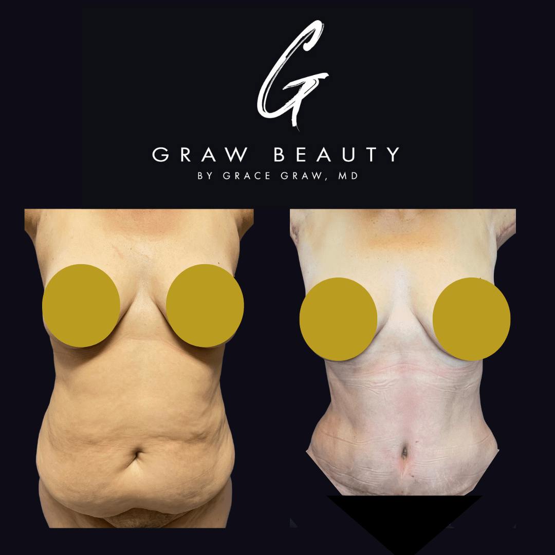 Abdominoplasty Before & After Gallery - Patient 122446281 - Image 1